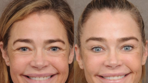 Denise Richards’ Doctor Shares Photos Before and After Facelift