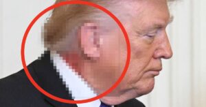 Donald Trump Has A Rash-Like Splotch On His Neck, And The Pic Is Reigniting Health Concerns